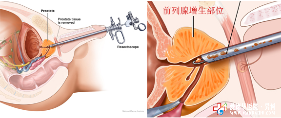 患了前列腺增生不治療危害大嗎?