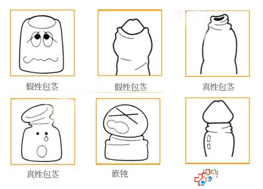 2012九江哪里做包皮手術好？九江醫大醫院