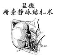 腹腔鏡下精索靜脈曲張微創術
