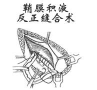 鞘膜積液反正縫合術