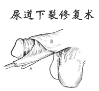 尿道下裂修復術