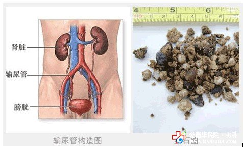 膀胱結石的危害如何