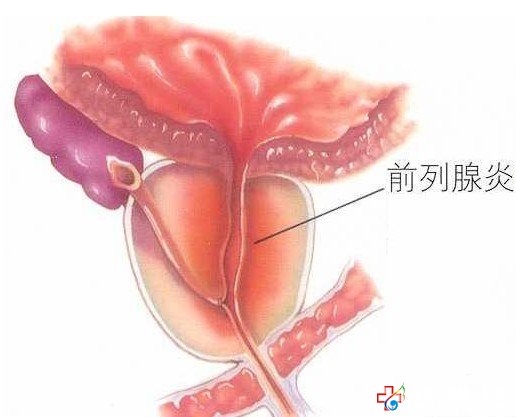 引起細菌性前列腺炎反復發作的原因