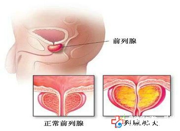 治療前列腺增生什么技術可以治愈？—九江男科醫院