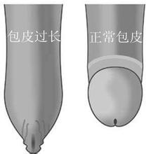 五歲男孩陰莖包皮內側有包